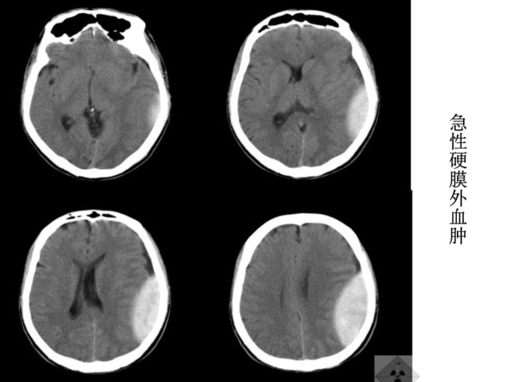亚急性硬膜下血肿:呈新月形或半月形,血肿密度呈高密度或等密度.
