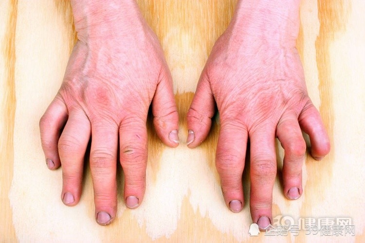 尿酸高就是得痛风吗?答案直接告诉你,别瞎猜了