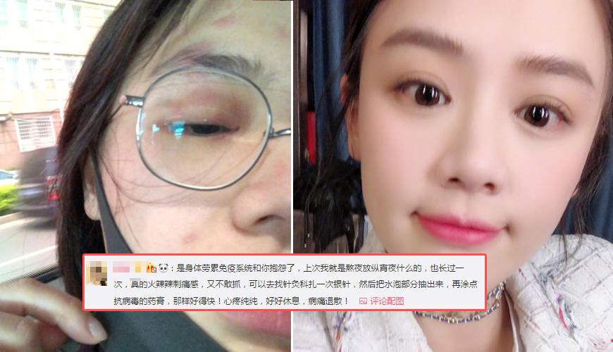 女星皮肤过敏堪比毁容,舒淇暂别娱乐圈陈乔恩