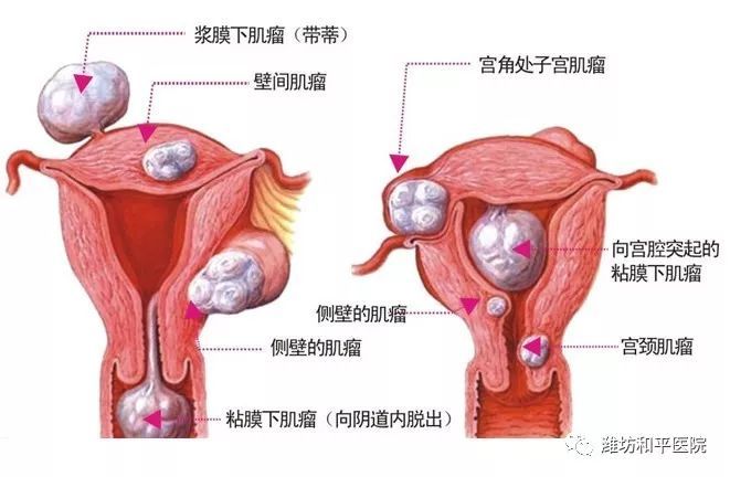 一般子宫肌瘤大于5cm,就具备了手术指征; b.