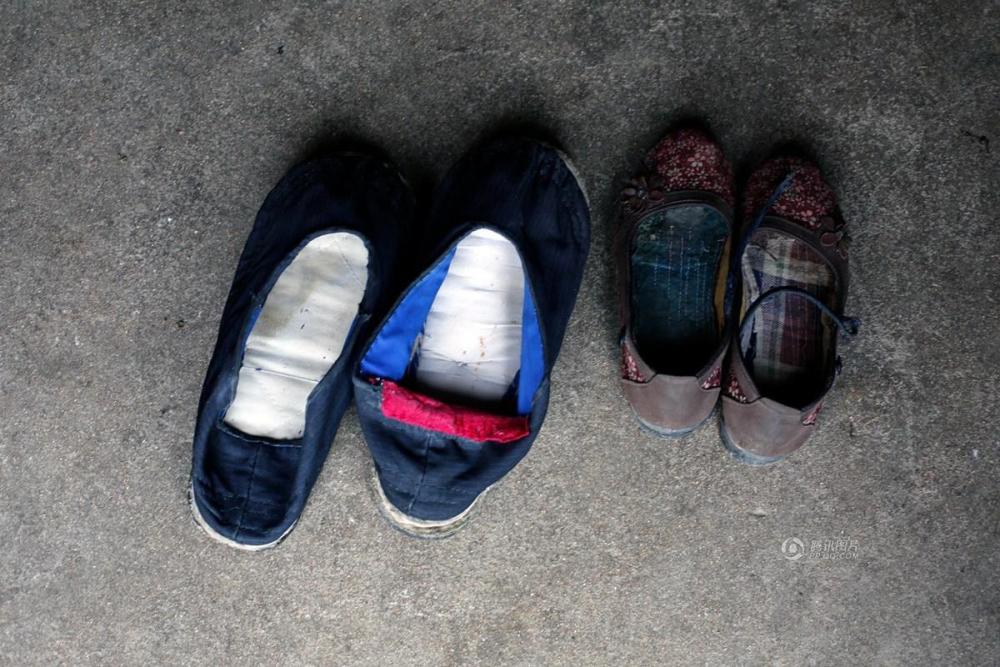 安徽男子患怪病腿肿如桶 渴望得到救治