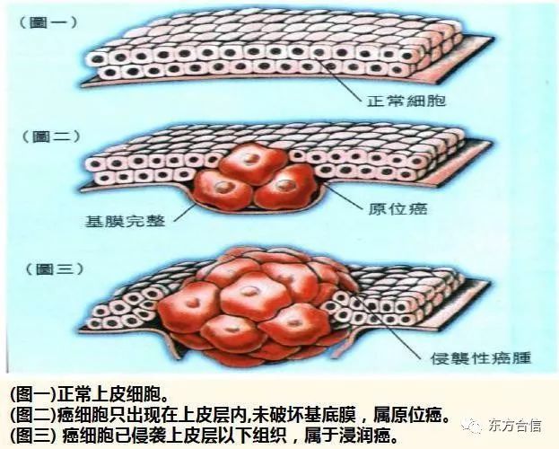 *注意宫颈上皮内瘤变(cin)不是原位癌,只是癌前病变!