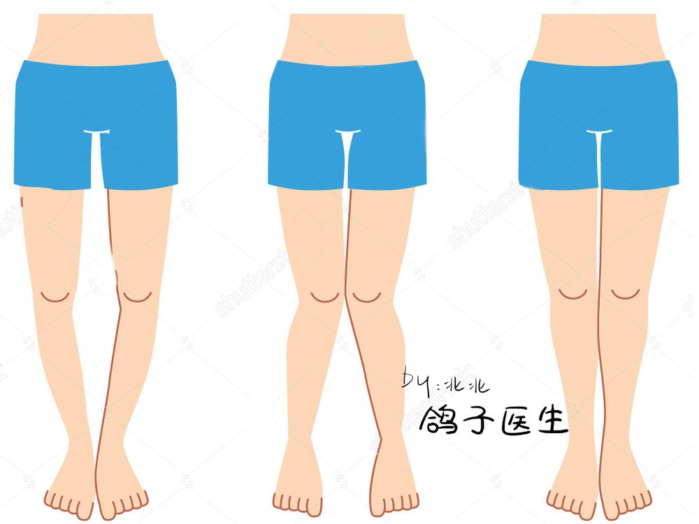 孩子走路八字脚,一定要趁早预防