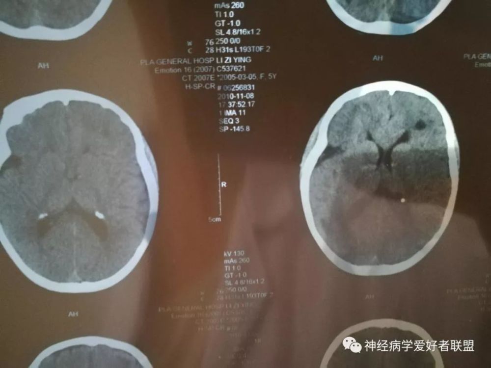 以癫痫为首发症状的结节性硬化