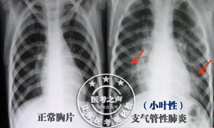 肺泡发生炎症 看图 所以,小叶性肺炎又叫 支气管性肺炎 细支气管和他