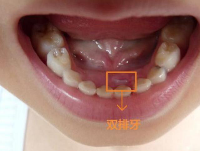8岁孩长出"两排牙",只因家长这个坏习惯,许多家庭都中招!