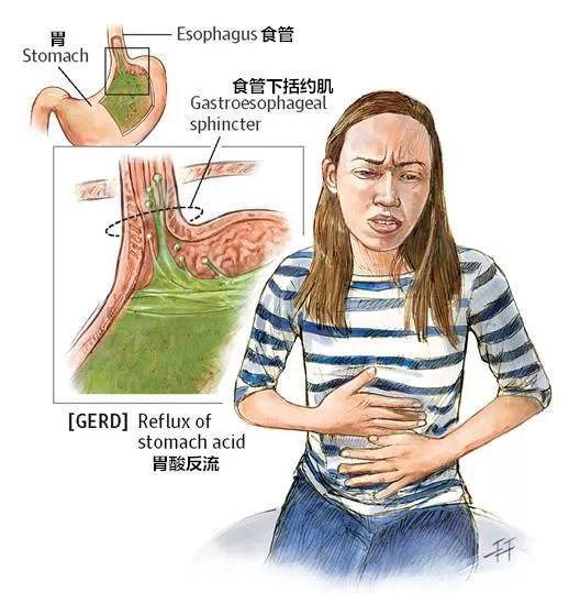胃食道反流 腾讯网