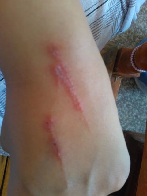 预警!隐翅虫又出来活动了 被它咬伤皮肤溃疡坏