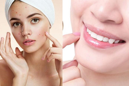 粉刺不挤自己会消掉吗 做好这几点烦恼自然消