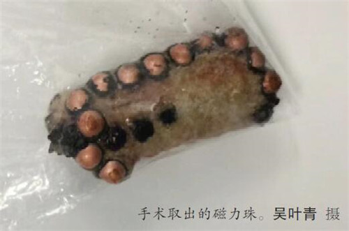 11岁男孩膀胱里藏着12颗磁力珠