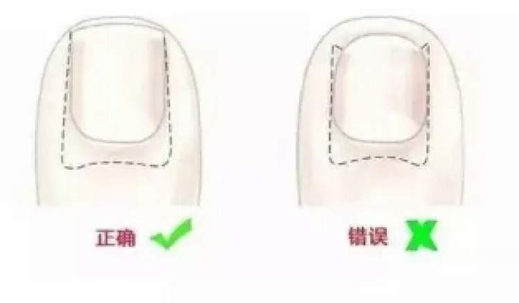 指甲可能是种病!这样剪指甲当心引发甲沟炎,很