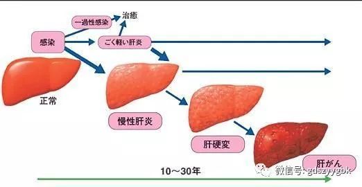 肝炎患者如何及早识别肝硬化?