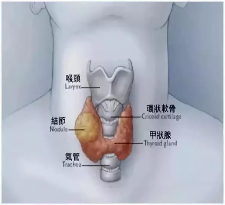 甲状腺为什么爱找女人麻烦?别担心,90%可治愈