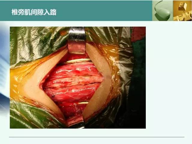 最全胸腰椎椎弓根置钉技术