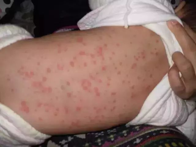 宝宝睡了一觉,身上莫名出了许多荨麻疹,原因或许是这个