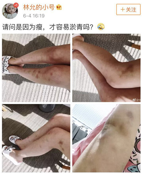 林允晒照双腿全是淤青,网友:像是被家暴了