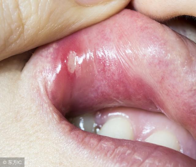 老年人口腔溃疡吃什么药_口腔溃疡吃什么药(2)