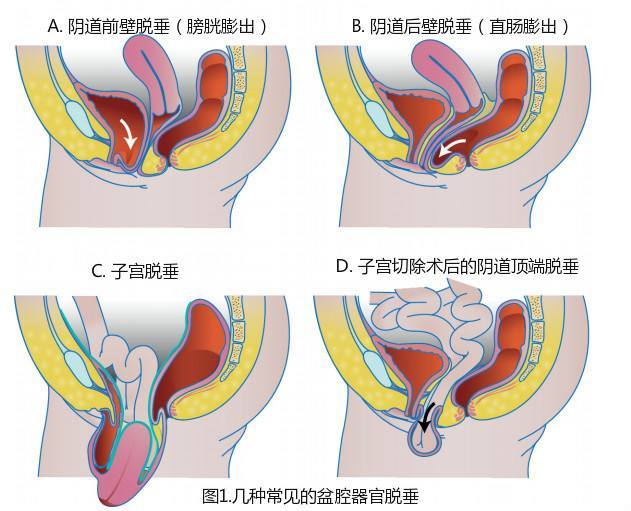 孕妇生完孩子一个月后,没有坐月子,导致自己子宫脱落