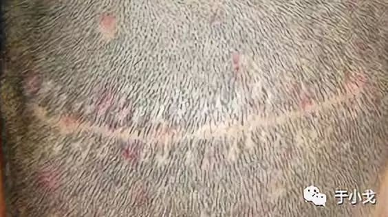 女明星发际线秃了,只能靠植发吗?血腥现场技术