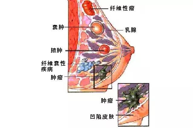 医生,我摸到了"乳房肿块",怎么办?