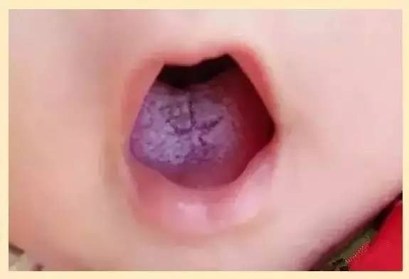 不良舌苔反映的5种问题 0~3个月的宝宝舌苔白厚,是由于宝宝自洁能力