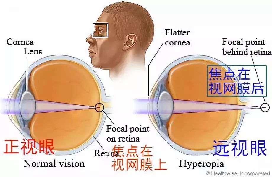 图二:远视眼