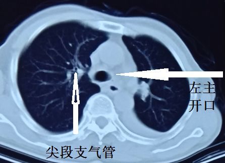 这种"胸水",做胸腔穿刺要出大事!