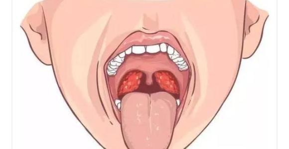 咽喉炎症状有哪些 看点快报