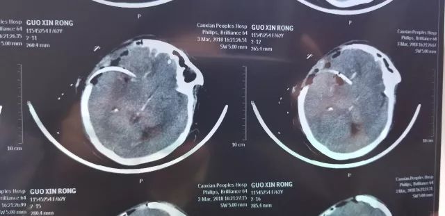 太惊险!右侧基底节脑出血+脑疝--与死神擦身而