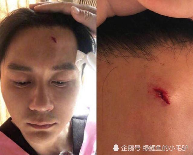 节目中受伤的明星,李晨额头缝9针,鹿晗腰伤复发,他从高空坠落