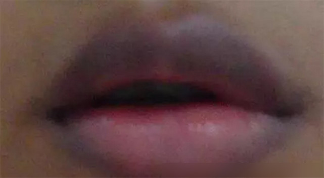唇部术后唇片发乌黑