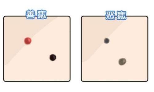 三个地方长善痣一生幸福