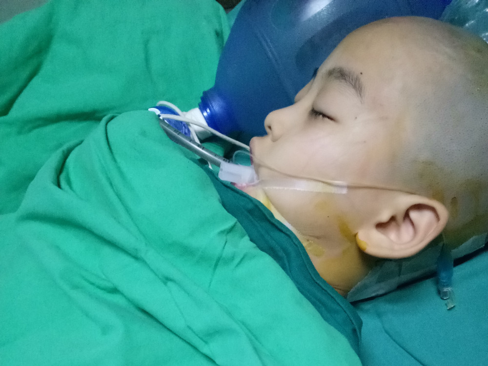 鸡蛋大小的脑肿瘤折磨男童 床前20个玩具记录