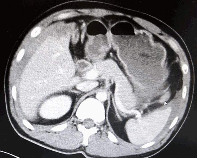 从ct检查发现, 患者肝脏中央型挫裂伤,肝静脉汇入下腔静脉处撕裂伴
