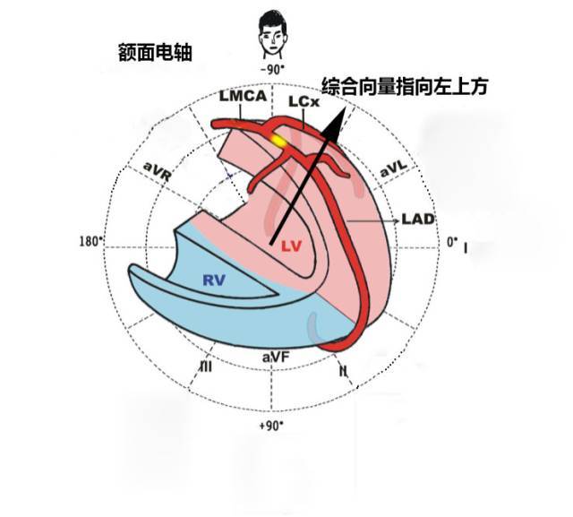 avr 导联 st 段压低, 讨论:由于 avr 导联 st 段无移位,因此额面电轴