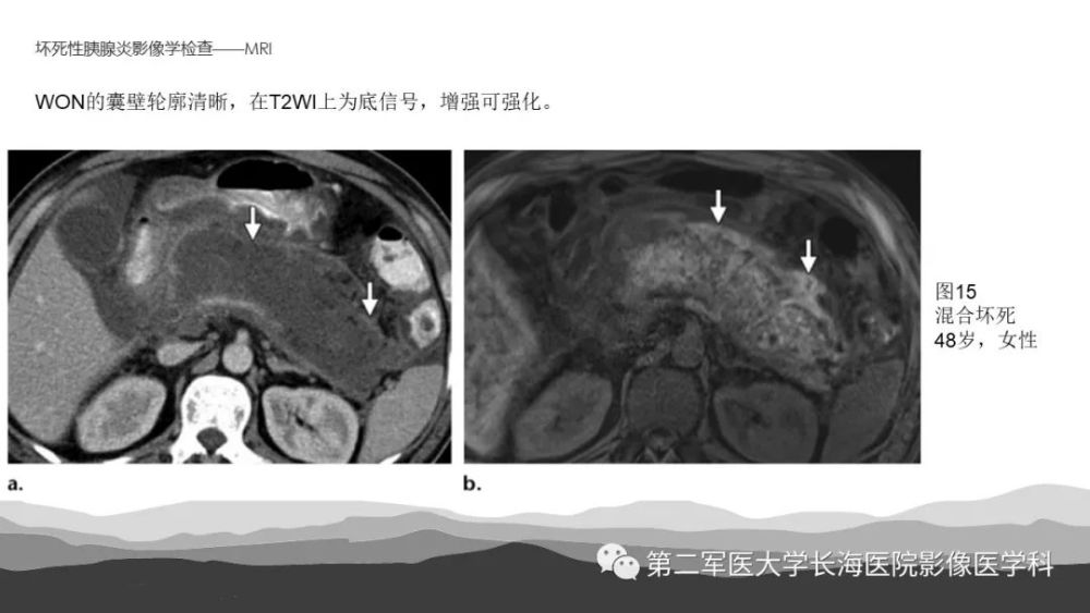 坏死性急性胰腺炎的影像诊断和治疗