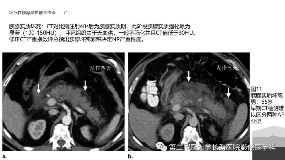 坏死性急性胰腺炎的影像诊断和治疗