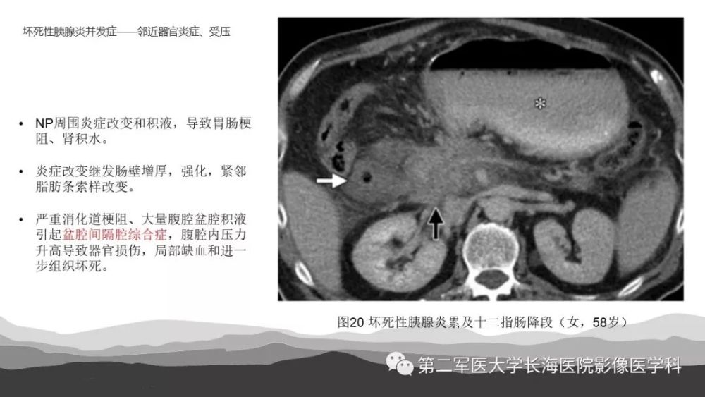 坏死性急性胰腺炎的影像诊断和治疗