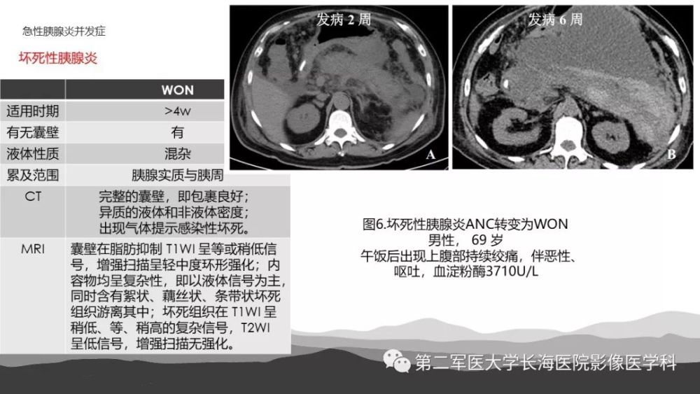 坏死性急性胰腺炎的影像诊断和治疗