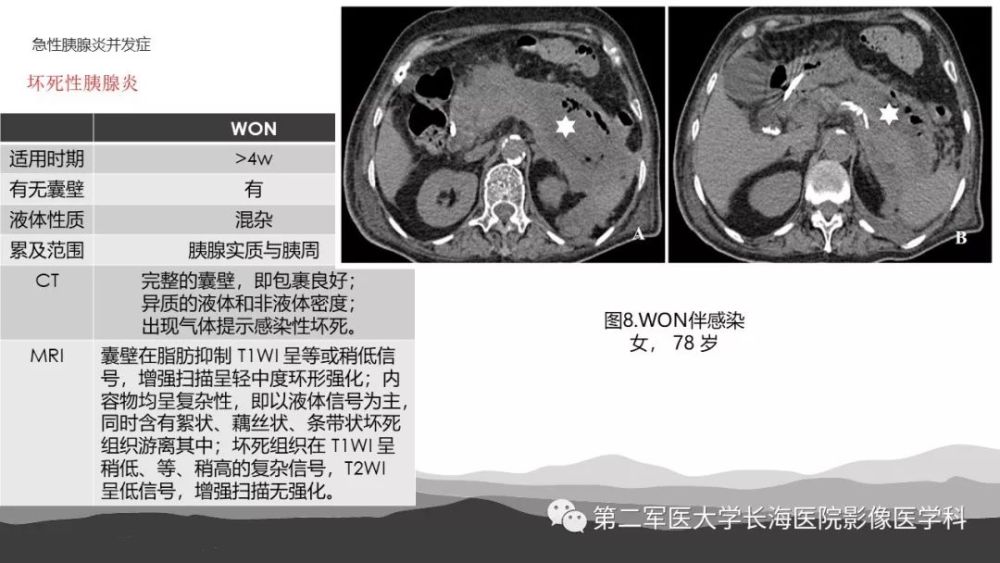 坏死性急性胰腺炎的影像诊断和治疗
