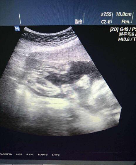 孕妈做B超时,医生弄错胎儿的性别,都是它在捣