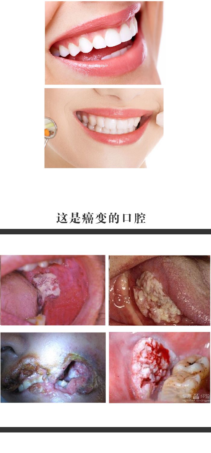 男子痴迷吃槟榔,结果患上口腔癌!