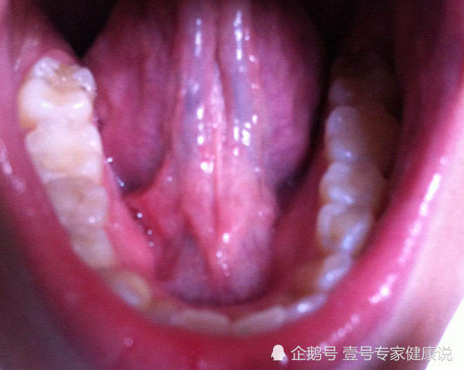 舌头上有这些表象,说明你瘀血很严重,小心心脏病