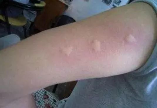 鉴别:被蚊子叮过的地方会出现 隆起的小红圆点或小肿块,一会儿后