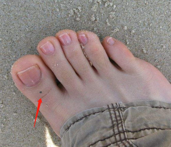 脚上长黑痣还能看出一个人的运势如何!快来看