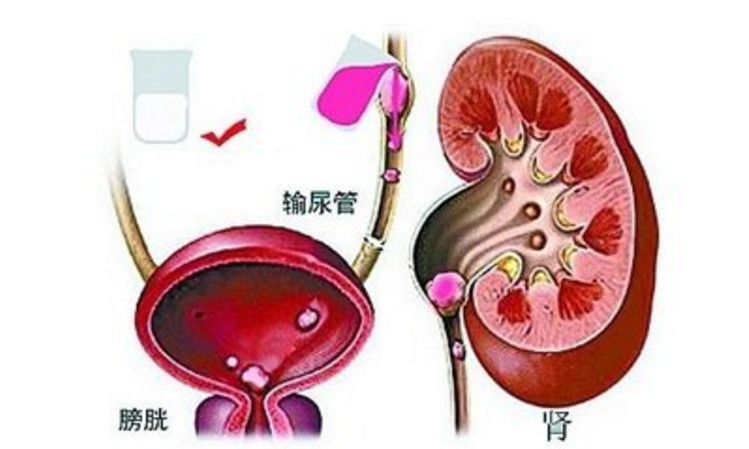 肾结石和输尿管结石有什么区别?哪个更严重?你可能刚知道