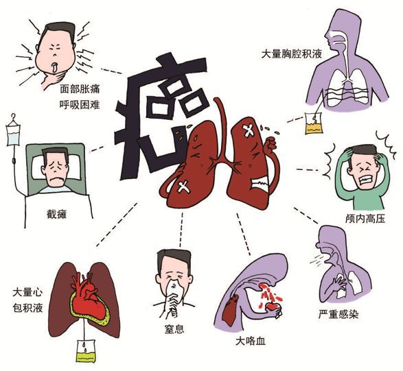 肺癌引起常见的首发症状表现为刺激性干咳,胸闷,咯痰,咯血,喘累,甚至