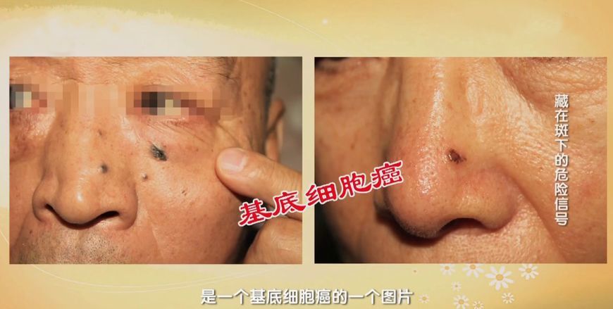 脸上长了这种 斑 可能是基底细胞癌 看点快报