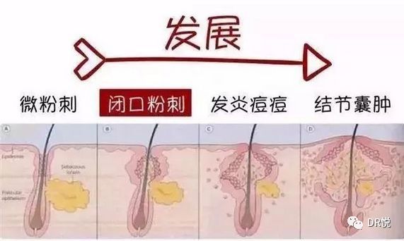 防晒擦不对容易闷痘?医生告诉你痘痘的真相!