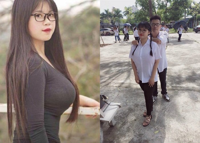 越南18岁少女胸围110cm,做三次手术才能减负成功